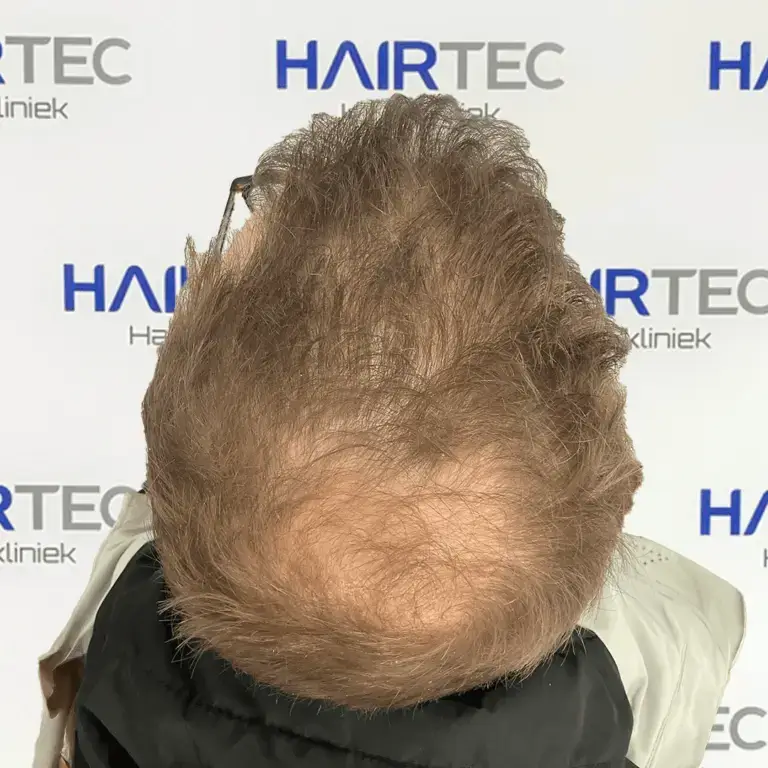 graaf before and after photo voor