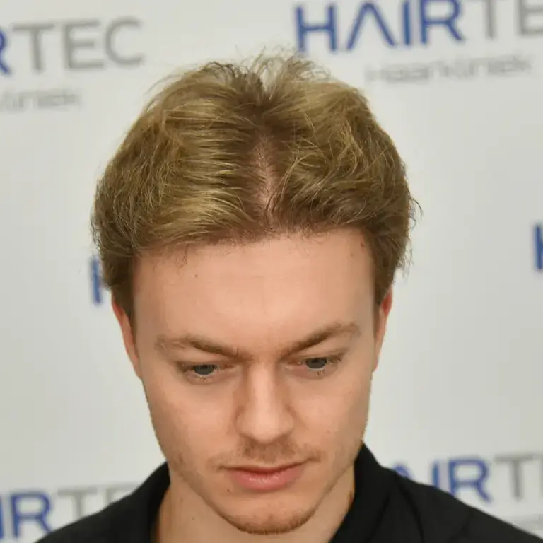 jurriaan before and after photos na