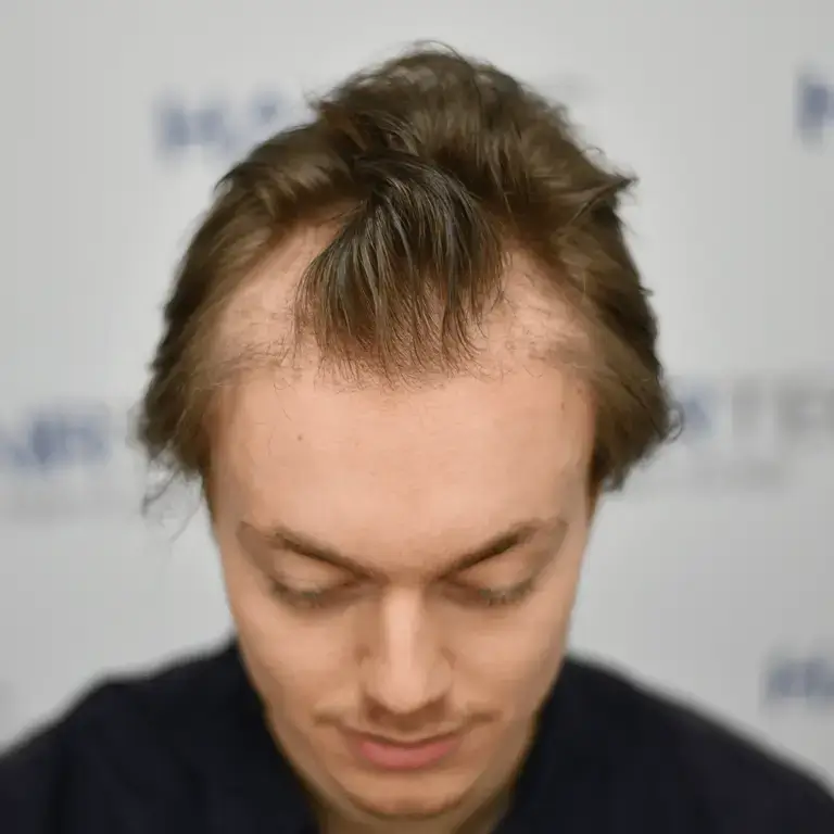 jurriaan before and after photos voor