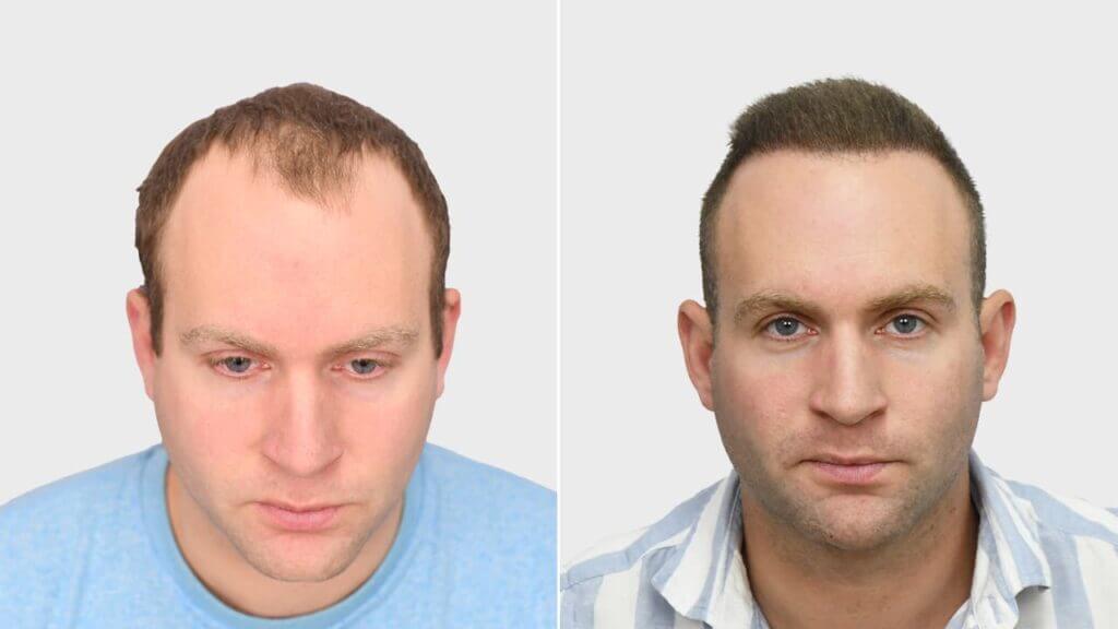 Hairline restoration before and after - Hairtec patient