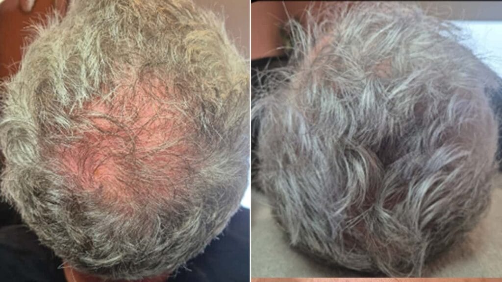 XL Hair treatment before and after for thinning hair