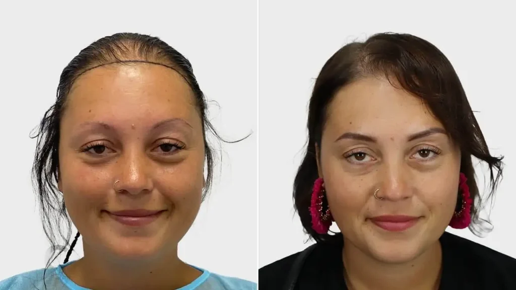 Female hair transplant before and after result at Hairtec